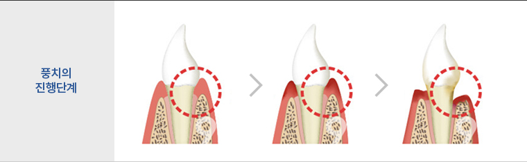 풍치의 진행단계